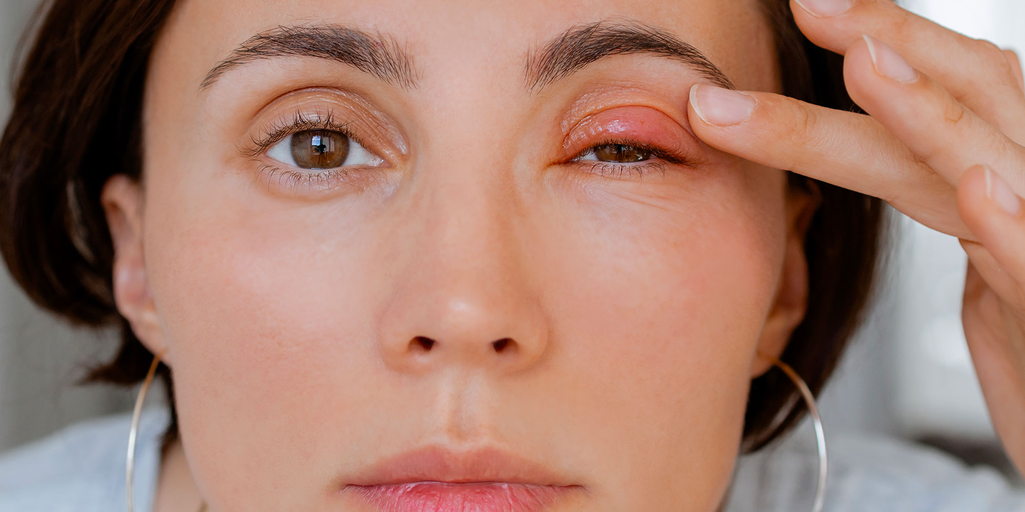 Chalazion